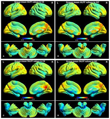 Abnormal Low-Frequency Oscillations Reflect Abnormal Eye Movement and Stereovision in Patients With Comitant Exotropia